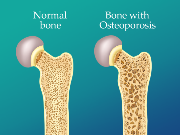 Osteoporosis prevention