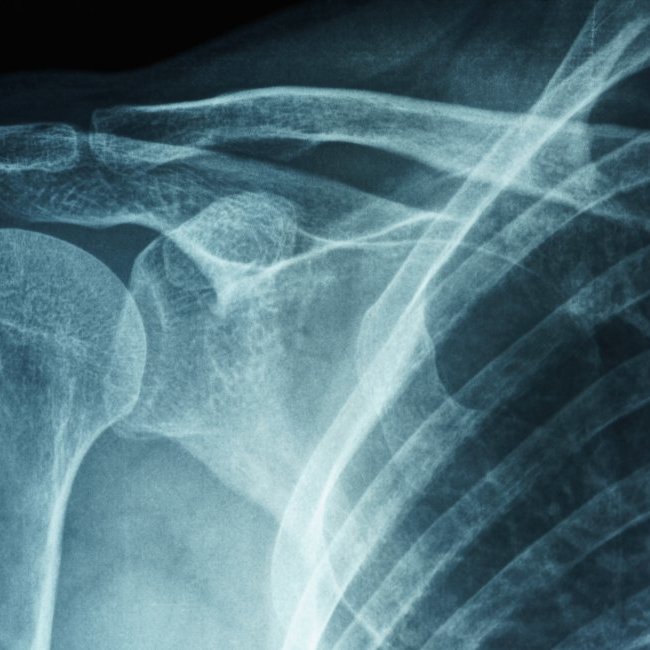 Frozen Shoulder (Adhesive Capsulitis)